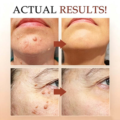 LAST DAY 50% OFF Tags & Moles Remover
