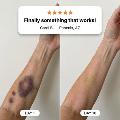 💥100K+ SOLD💕- Bruise Repair & Skin-Strengthening Cream